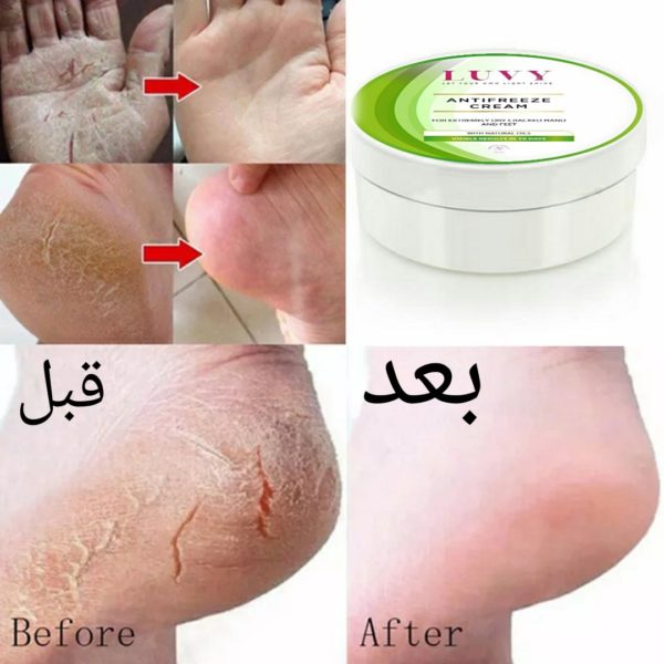 كريم لوفي لعلاج تشققات البشرة